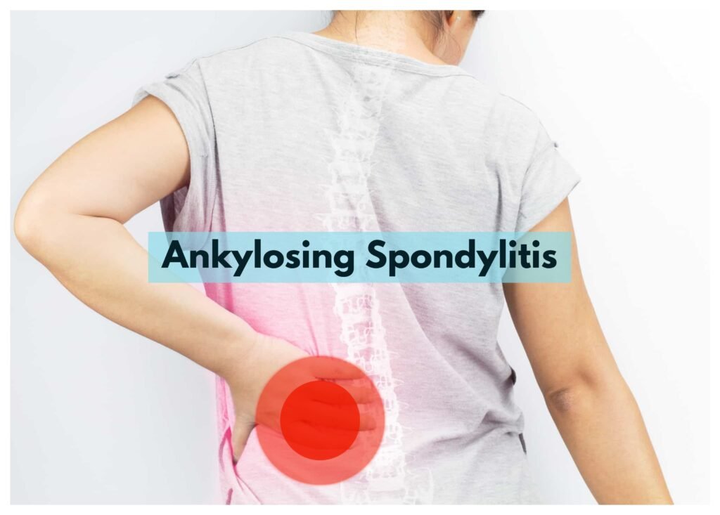 Ankylosing spondylitis is a type of inflammatory arthritis primarily affecting the spine, which results in inflammation and stiffness of the vertebrae.