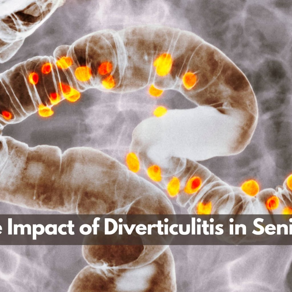 The Impact of Diverticulitis in Seniors