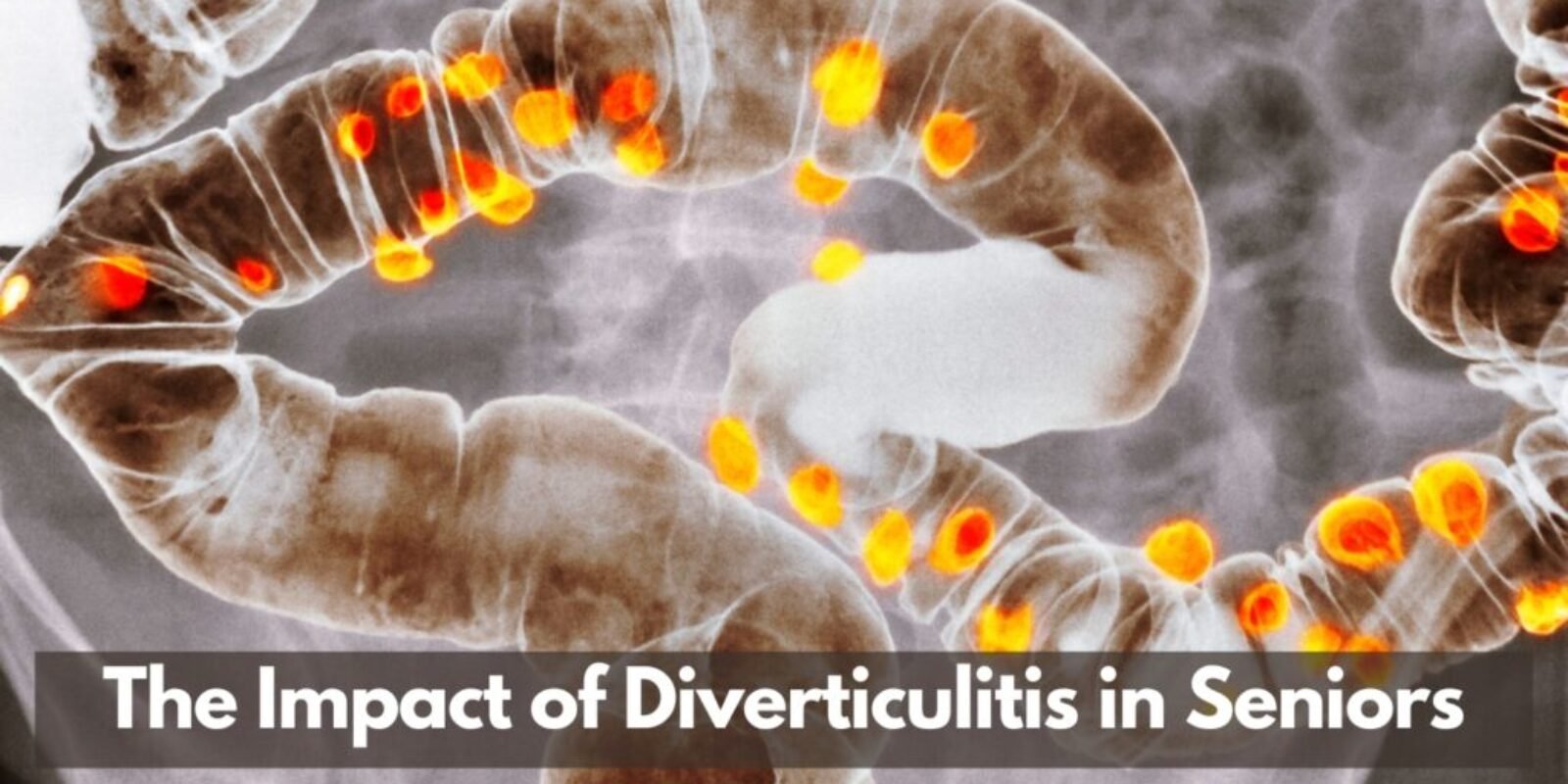 The Impact of Diverticulitis in Seniors