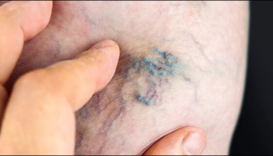 Seniors' Varicose Veins: A Common Problem with Surprising Solutions